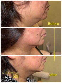 フィオーレ(fiore)/頬と顎が人気のレモンボトルで！