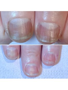 ココデネイル(cocode nail)/悩み:爪噛み(30代後半)