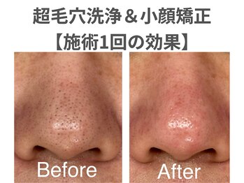 ノア 川越店(NOAH)/小顔矯正コルギ&毛穴洗浄