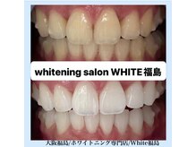 ホワイトニングサロン ホワイト(WHITE)/セルフホワイトニング/大阪/福島