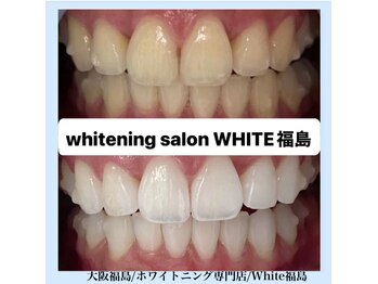 ホワイトニングサロン ホワイト(WHITE)/セルフホワイトニング/大阪/福島