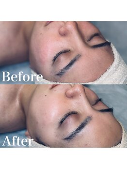 エクリア(ECLIA)/フェイシャル Before⇒After