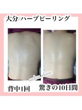 サロンシャイン(Salon Shine)/ハーブピーリング1回
