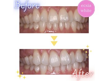 エクシアホワイト 浦安店/ホワイトニングビフォーアフター