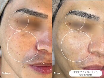 フォンビューティー(fon beauty)/しみ・しわケア1ヶ月・3回