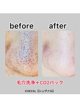 シュバル(CHEVAL)/毛穴洗浄しませんか？