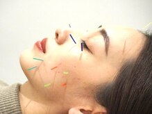 鍼灸整骨院スセリ(Suseri)/美容鍼灸