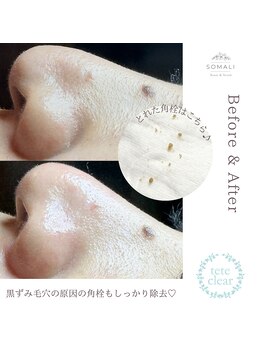 ソマリ(SOMALI)/4回目 女性 Before & After