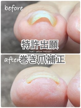 モストネイル 五日市店(MOST nail)/特許出願の巻き爪補正メニュー