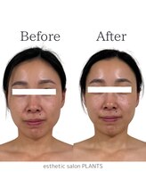 プランツ(PLANTS)/20代／１回／くすみ・小顔