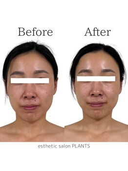 プランツ(PLANTS)/20代／１回／くすみ・小顔