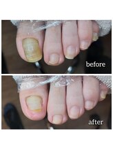 爪切り屋 足楽/【肥厚爪】