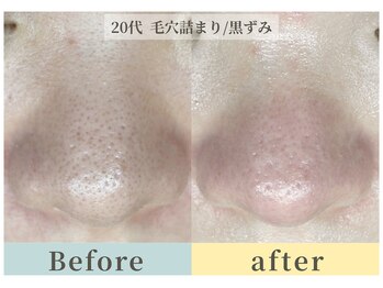 ムク(Muqu.)/毛穴EXで長年の詰まりを除去。