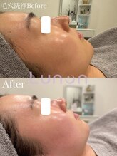 ルノン(Lunon)/毛穴洗浄ハイドロ