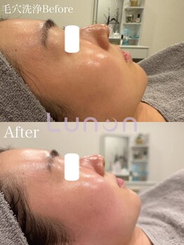 ルノン(Lunon)/毛穴洗浄ハイドロ