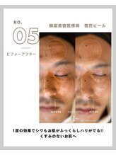 ラ メール(La mer)/★雪花ピール BeforeAfter★