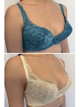 美人バスト 福岡店/バストアップ ◇症例◇