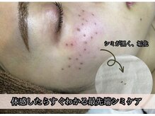 ティエル 恵比寿店(Tiele)/シミケア症例