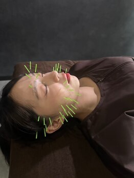 クリアランス 南青山(CLEARANCE)の写真/RE:FACE｜美容鍼×電気鍼｜即効実感　NO.1 【初回限定】60分　8250円