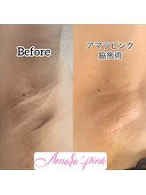 フジモトサロン 那覇おもろまち店(fujimotoサロン)/脇の黒ずみ・くすみ撃退