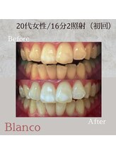 ブランコ 川口店(Blanco)/セルフホワイトニング☆症例写真