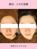 【速攻美肌×透明感UP】ニキビケア！白玉フェイシャルで輝くツヤ肌へ！