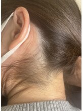 フレドネ(FREDONNER)/うなじワックス脱毛Ｂｅｆｏｒｅ