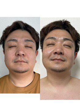 モモラ(Spa MoMora)/人気のメンズフェイシャル白金台