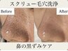 毛穴黒ずみ・詰まり集中改善コース　初回体験5500円【本気で毛穴に悩む方】