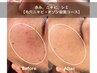 8月限定【赤みニキビ/シミ】毛穴/ニキビ/美白+NMNパック導入¥25000→¥8800