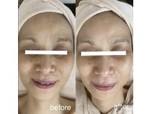 サロン ド ソワン(salon de soin)/毛穴エクストラクション・ハーブ