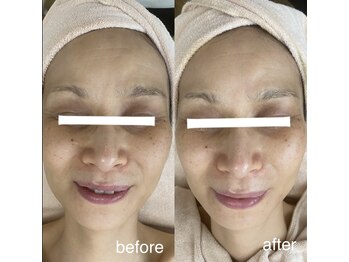 サロン ド ソワン(salon de soin)/毛穴エクストラクション・ハーブ