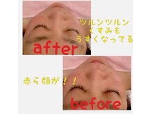 アンリール 旭川店(Anrire)/フェイシャル施術のお客様です！