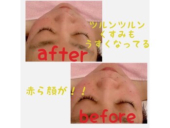 アンリール 旭川店(Anrire)/フェイシャル施術のお客様です!