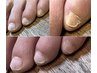 F夏前準備 人気No.2【埋もれ爪・副爪対応 足爪ケア】清潔感ある足元へ