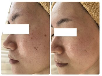 アップル 宇都宮店(Apple.)/純粋レチノールピール施術