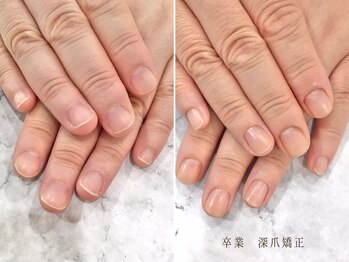 リファーレ(RIFARE)/【深爪矯正】憧れのお手元に♪