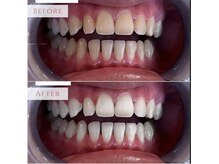 業界でも注目の【ポリリン酸】という強力な美白成分を贅沢に配合