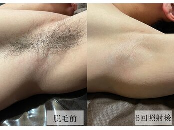 メンズアルファ/【脇】光脱毛before after 20代