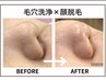 【人気No,1】黒ずみ撃退つるっと毛穴レス肌！透明感ツヤUP■毛穴洗浄×顔脱毛