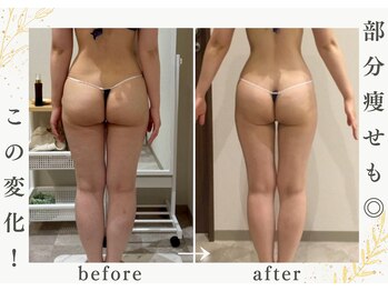 ナチュールファースト(naturel first)の写真/【部分だけケアしたい方！】隠してた部分、出せる身体へ。
気になるヒップと脚の脂肪を集中撃退！