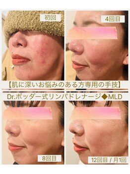 ホイ(Hui)の写真/【優しく軽いタッチで驚きの改善率】敏感肌や繰り返す赤み系の肌荒れに◆Dr.ボッダー式リンパドレナージMLD