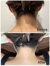 ハチ シンス 2023-(hachi-since 2023-)/うなじ脱毛　Before・After