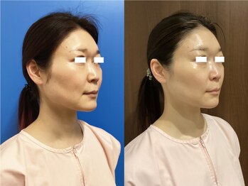 プリオール 太田店(Prior)/小顔コルギ