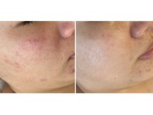 サロン エデンプラス(salon eden PLUS)/ハーブピーリング