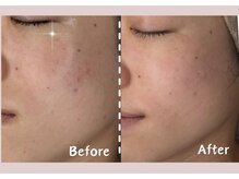 シー センター北(sii)/ララピールで美肌の土台作り