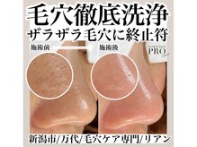 リアン(Riant)/毛穴ケアコース 