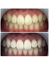 夏目ホワイトニングアンドネイル(夏目WHITENING＆NAIL)/セルフホワイトニング　3回施術