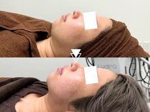 【最新小顔術】今話題！たるみを根本改善するリフトアップ施術！マイクロリフト13000円【たるみ改善/小顔】