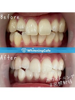 ホワイトニングカフェ 池袋東口店/ホワイトニングビフォーアフター